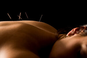 Acupuncture for Stress