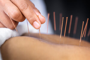 Does acupuncture hurt?